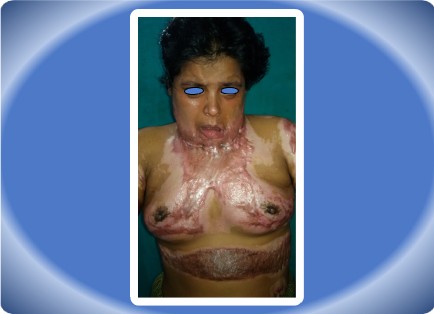POST BURN CONTRACTURE